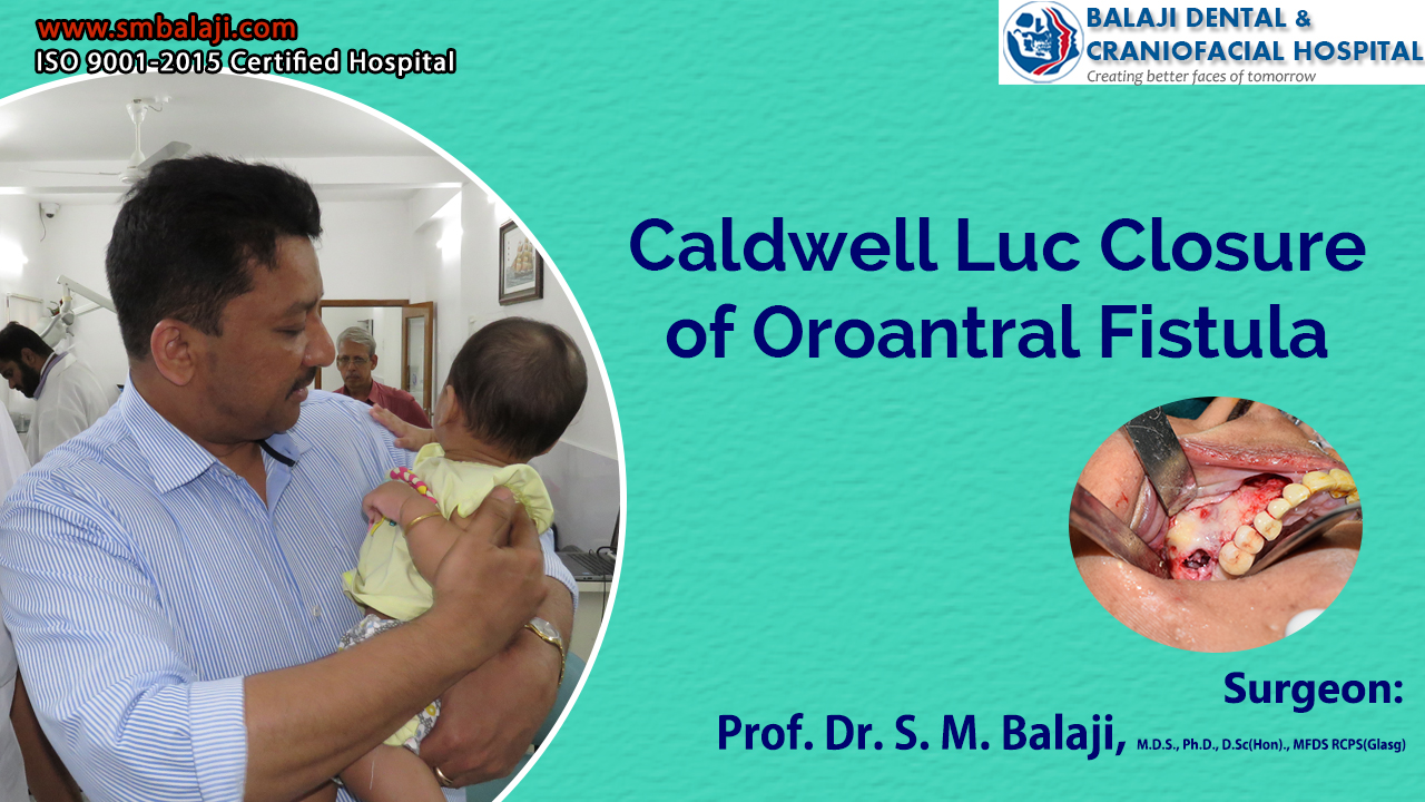 Caldwell Luc Closure of Oroantral Fistula