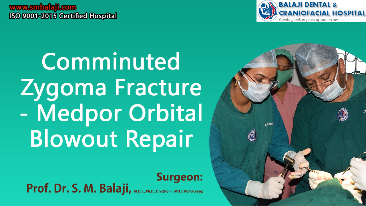 Comminuted Zygoma Fracture - Medpor Orbital Blowout Repair