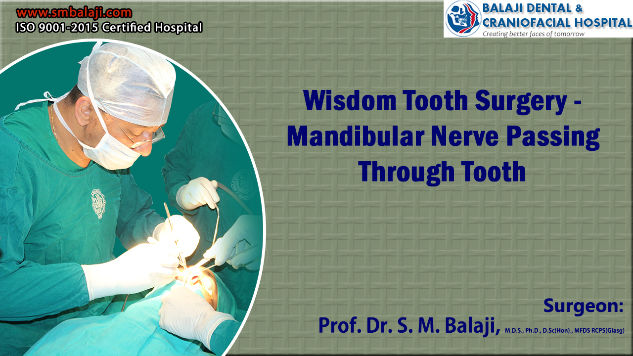 Wisdom Tooth Surgery - Mandibular Nerve Passing Through Tooth