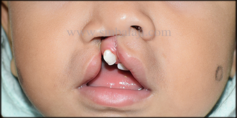 Unilateral Cleft Lip In A 11 Months Old Baby Boy