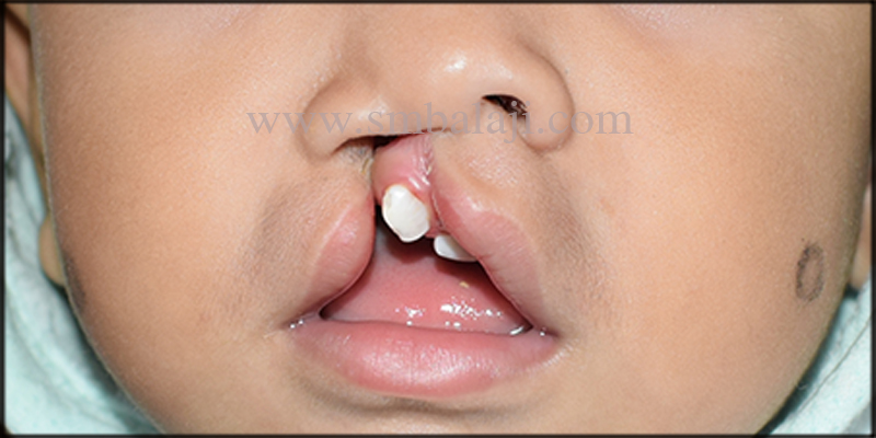 Successful Correction of Unilateral Cleft Lip 1 Unilateral Cleft Lip In A 11 Months Old Baby Boy