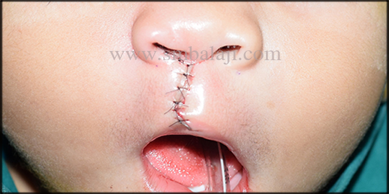 Primary Cleft Lip Repair Following Modified Millard’s Technique