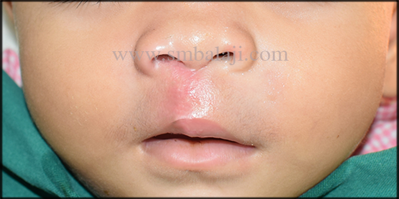 Successful Correction of Unilateral Cleft Lip 3 Immediately After Suture Removal Following Seven Days Of Surgery Showing Enhanced Appearance