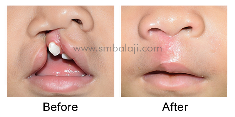 Successful Correction of Unilateral Cleft Lip 4 Before - After Surgery