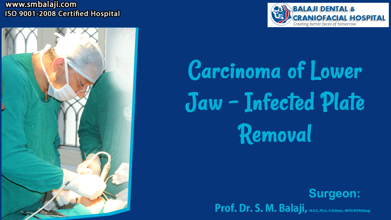 Carcinoma of Lower Jaw - Infected Plate Removal Surgery