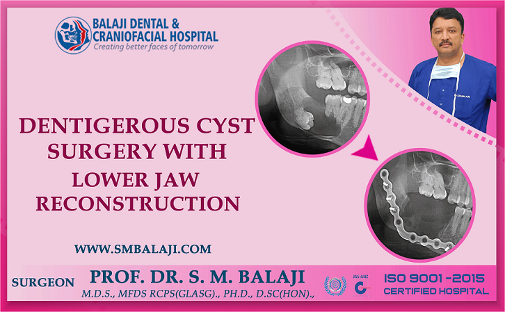 Dentigerous Cyst Surgery with Lower Jaw Reconstruction