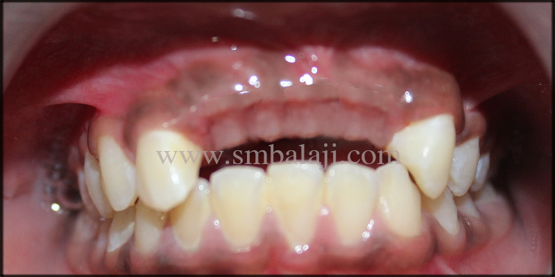Patient With Missing Upper Front Teeth