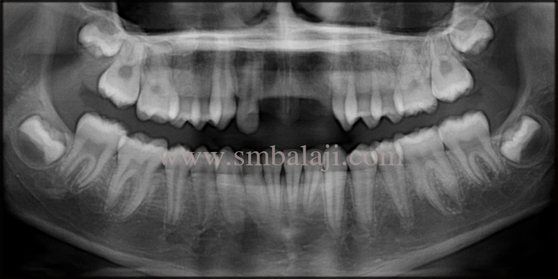 Pre-Operative Opg Shows Complete Missing Of Teeth At The Involved Site With No Pathological Findings In The Surrounding Bone Structure