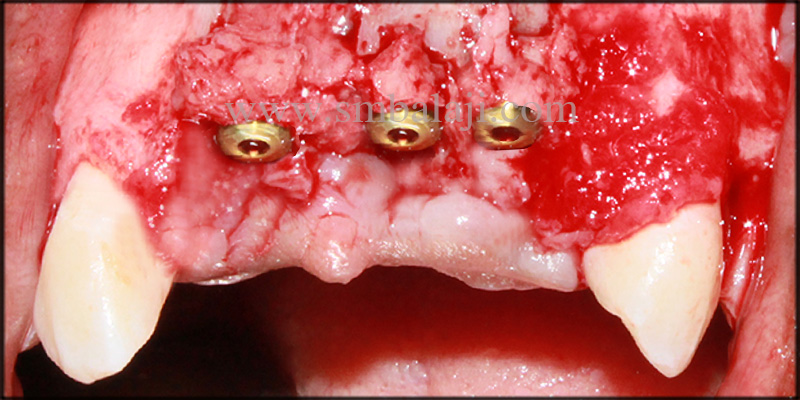 Dental Implants Fixed At The Relative Site