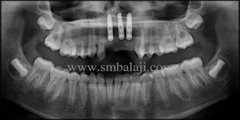 Post-Operative Opg Taken After 3Months Shows Well Osseointegrated Dental Implants