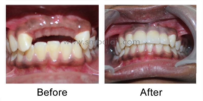 Replacement of Missing Teeth with Dental Implants for a Dazzling Smile