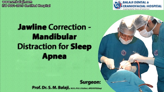 Jawline Correction - Mandibular Distraction for Sleep Apnea