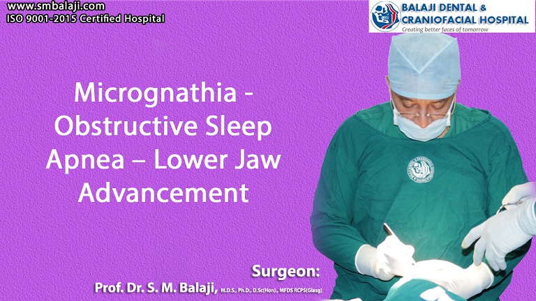 Micrognathia - Obstructive Sleep Apnea – Lower Jaw Advancement