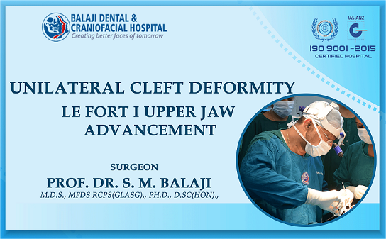 Unilateral Cleft Deformity – Le Fort I Upper Jaw Advancement