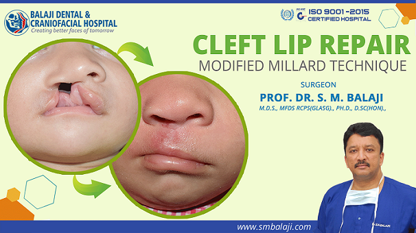 Cleft Lip Repair Surgery – Modified Millard Technique