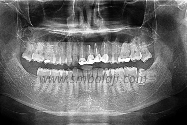Upper Jaw Reconstruction with Rib Graft and Dental Implants 1 Upper Jaw Reconstruction With Rib Graft And Dental Implants