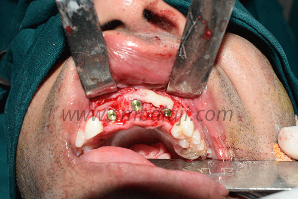 Upper Jaw Reconstruction with Rib Graft and Dental Implants 2 Upper Jaw Reconstruction With Rib Graft And Dental Implants