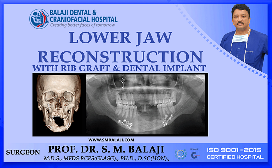 Lower Jaw Reconstruction with Rib Graft and Dental Implant