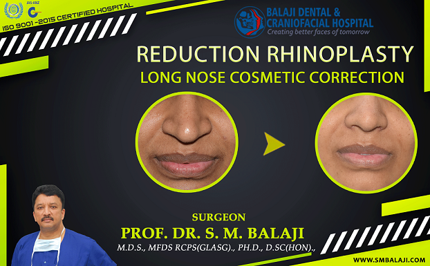 Reduction Rhinoplasty – Long Nose Cosmetic Correction