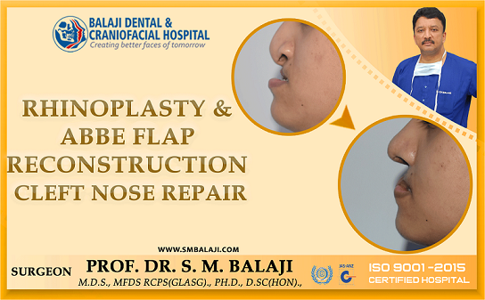 Rhinoplasty and Abbe Flap Reconstruction - Cleft Nose Repair