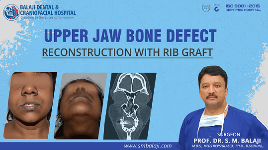 Upper Jaw Bone Defect - Reconstruction with Rib Graft