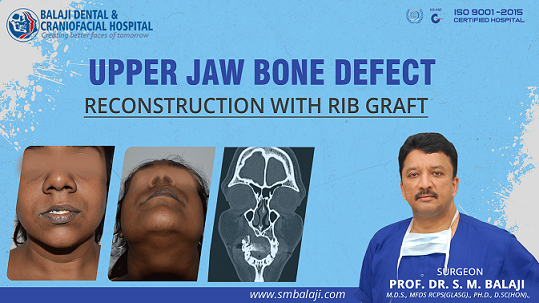 Upper Jaw Bone Defect – Reconstruction with Rib Graft