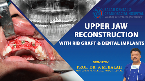 Upper Jaw Reconstruction with Rib Graft and Dental Implants