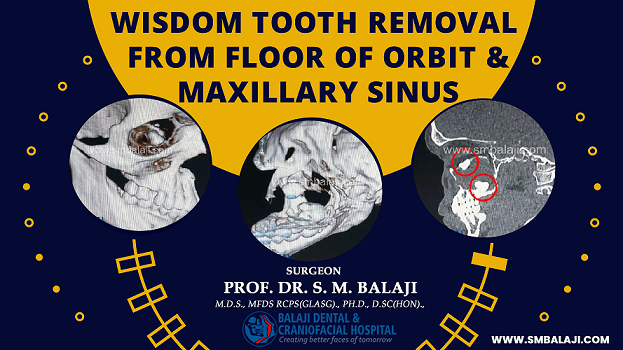 Wisdom Tooth Removal from Floor of Orbit and Maxillary Sinus