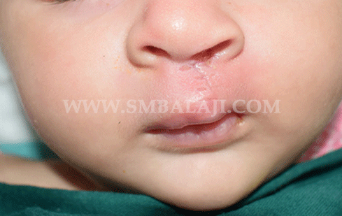 Cleft Lip Surgery - After Picture