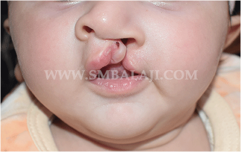 Cleft Lip Surgery - Before Picture