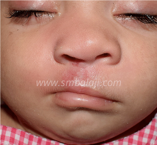 Cleft Lip Repair Surgery