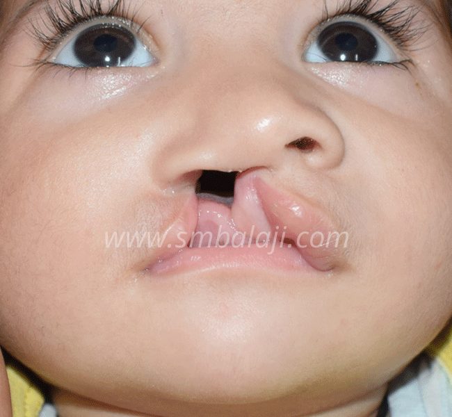 Cleft Lip Repair Surgery