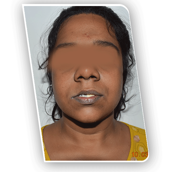 Upper Jaw Bone Defect - Reconstruction with Rib Graft 1 Upper Jaw Bone Defect