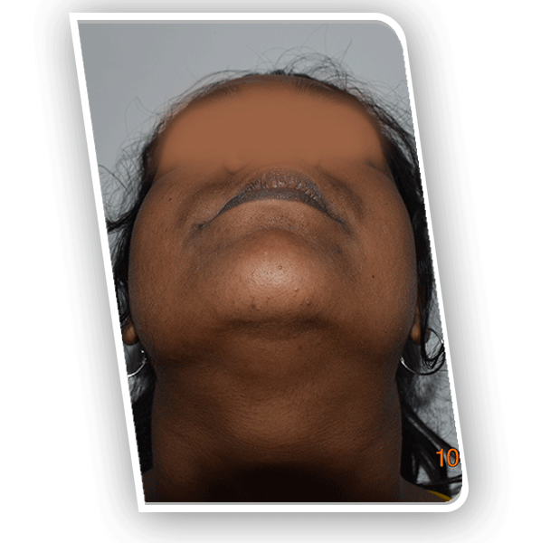 Upper Jaw Bone Defect - Reconstruction with Rib Graft 2 Upper Jaw Bone Defect