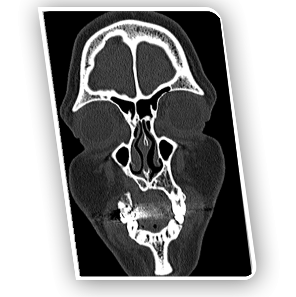 Upper Jaw Bone Defect