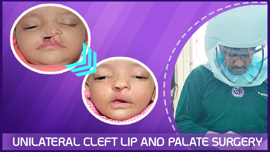 Unilateral Cleft Lip and Palate