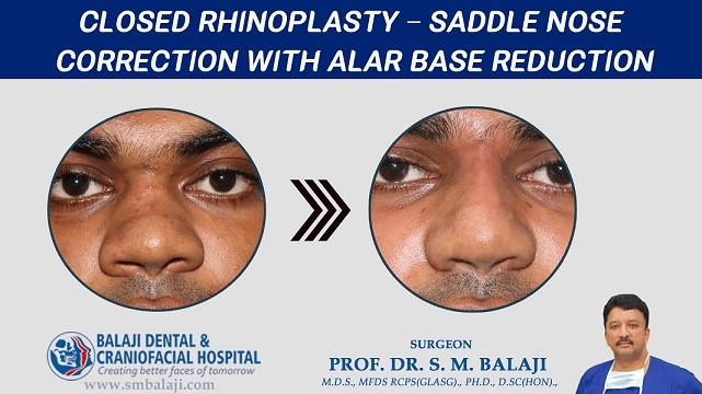 Closed Rhinoplasty – Saddle Nose Correction with Alar Base Reduction