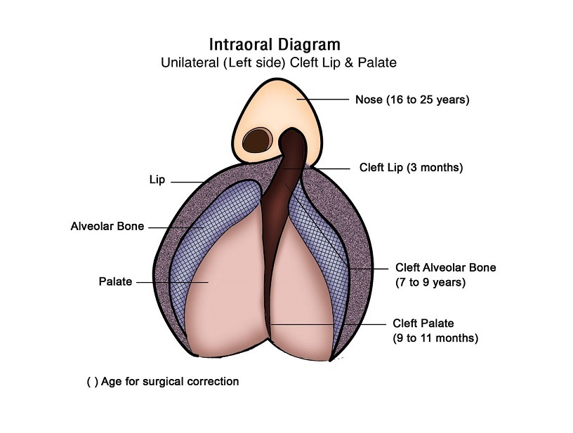 Intraoral Diagram Cleft Lip And Palate