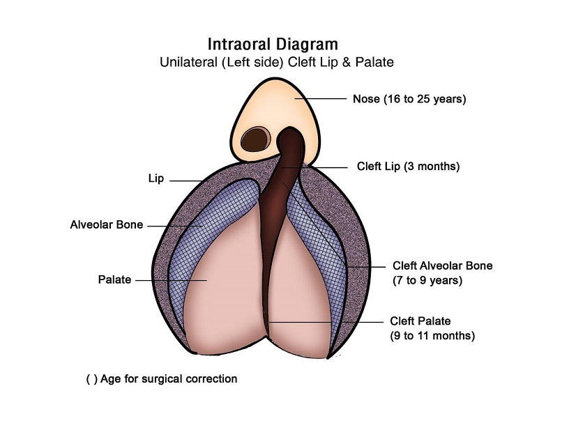Intraoral Diagram Cleft Lip and Palate Intraoral Diagram Cleft Lip And Palate