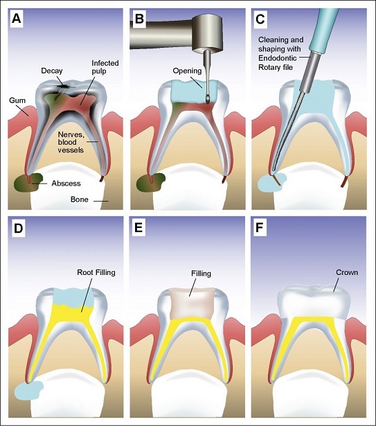 Root Canal Treatment Cost In Chennai