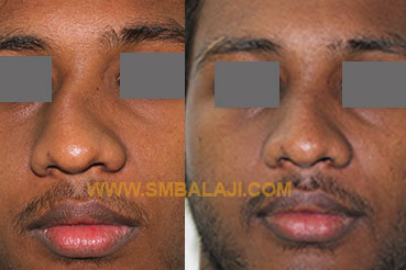 Rhinoplasty Before After