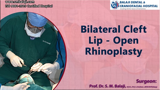 Bilateral Cleft Lip – Open Rhinoplasty