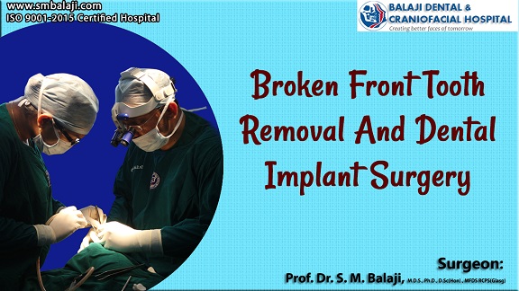 Broken Front Tooth Removal and Dental Implant Surgery
