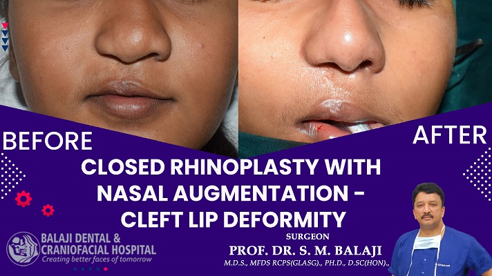 OPEN VS CLOSED RHINOPLASTY WHICH TECHNIQUE IS BEST?