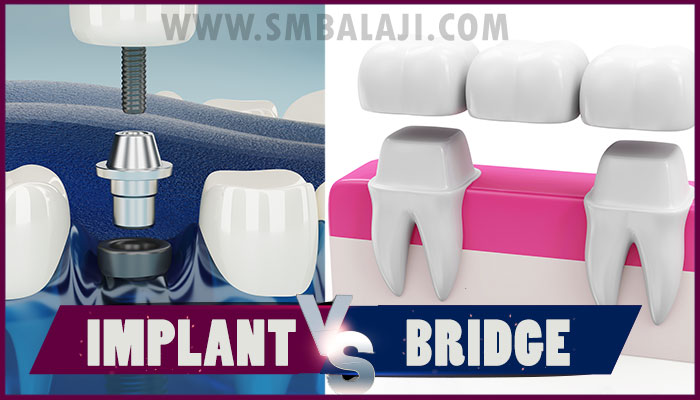 Dental Implant vs Bridge