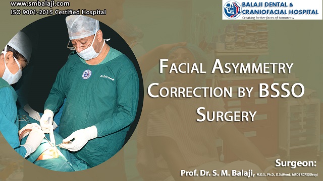 Facial Asymmetry Correction by BSSO Surgery