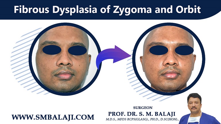 Fibrous Dysplasia of Zygoma and Orbit