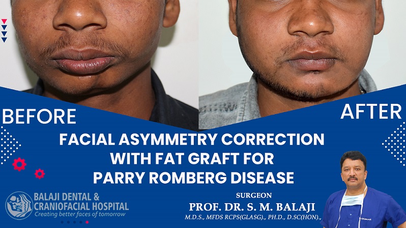 Facial Asymmetry Correction with Fat Graft for Parry Romberg Disease