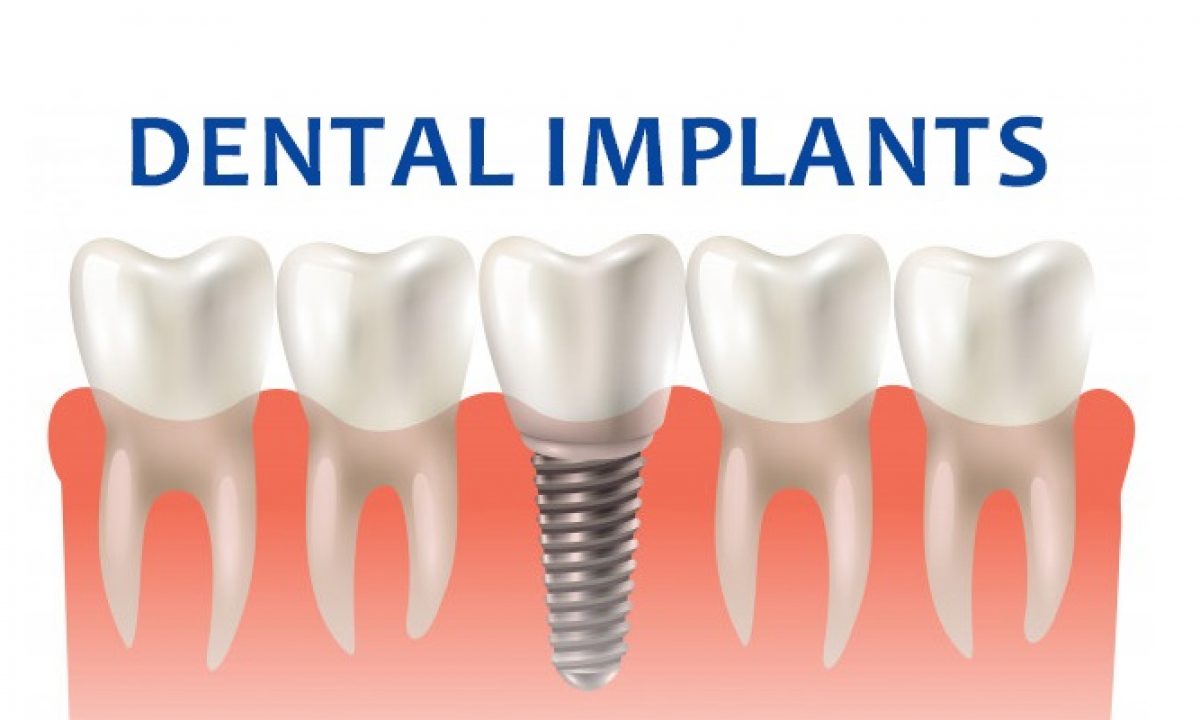 Dental Implant | Balaji Dental and Craniofacial Hospital, Chennai, India