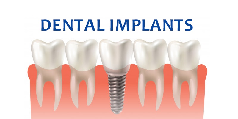 Best Dental Implant Clinic in India